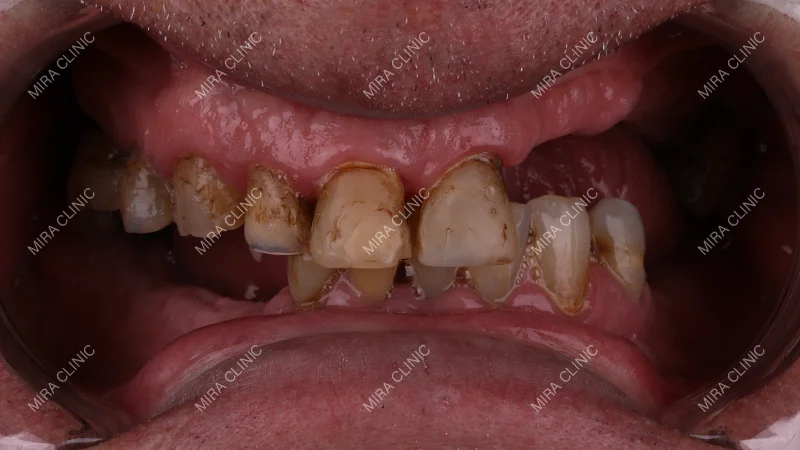 Candidate for Zirconium Crowns